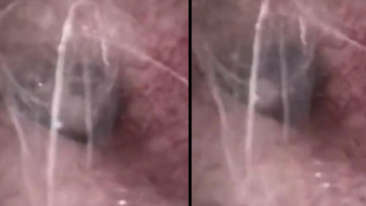 Doctors Shocked to Find Spider Spinning Webs Inside Man's Ear