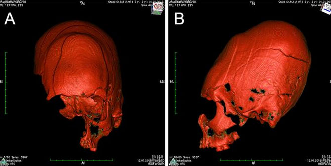 Can DNA Solve the Mystery of Europe's Elongated Skulls?