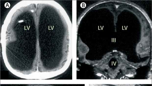 The Mystery of a Man Living with 90% of His Brain Missing