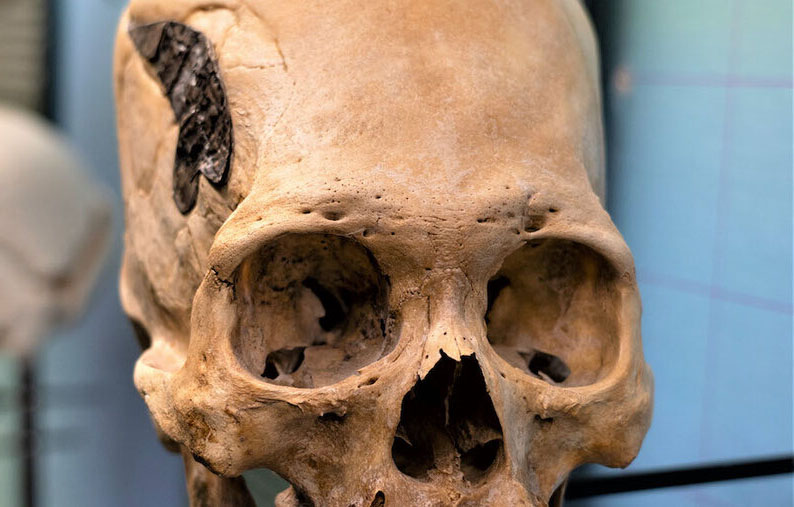 Scientists Study Elongated Skull with Mysterious Metal Implant