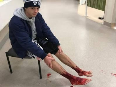 Australian Teen's Feet Bloodied by Mystery Sea Creatures
